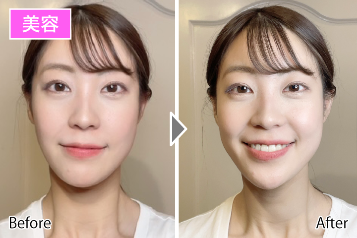 表情筋トレーニング